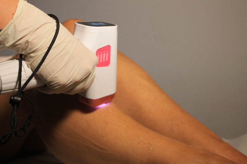 Disparo del laser Trionda sobre la pierna en Glo&Beauty Badalona